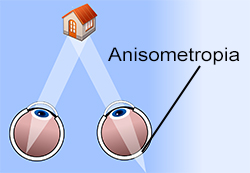 anisometropia