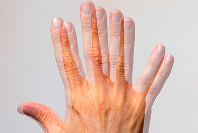 diplopia