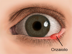 Bruciore e arrossamento occhi